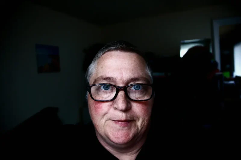 Woman with facial redness and rosacea flare-up, a common symptom triggered by alcohol during menopause